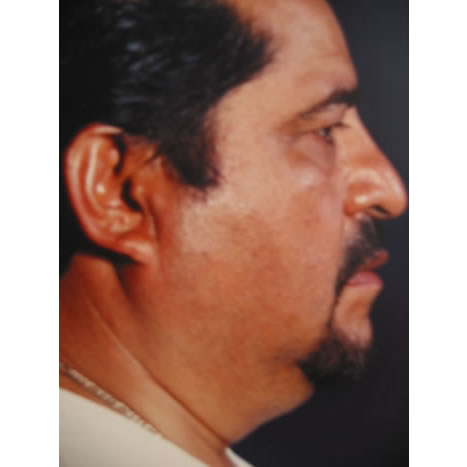 Liposucción Vaser-Láser