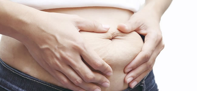 Abdominoplastia Vs. Embarazo
